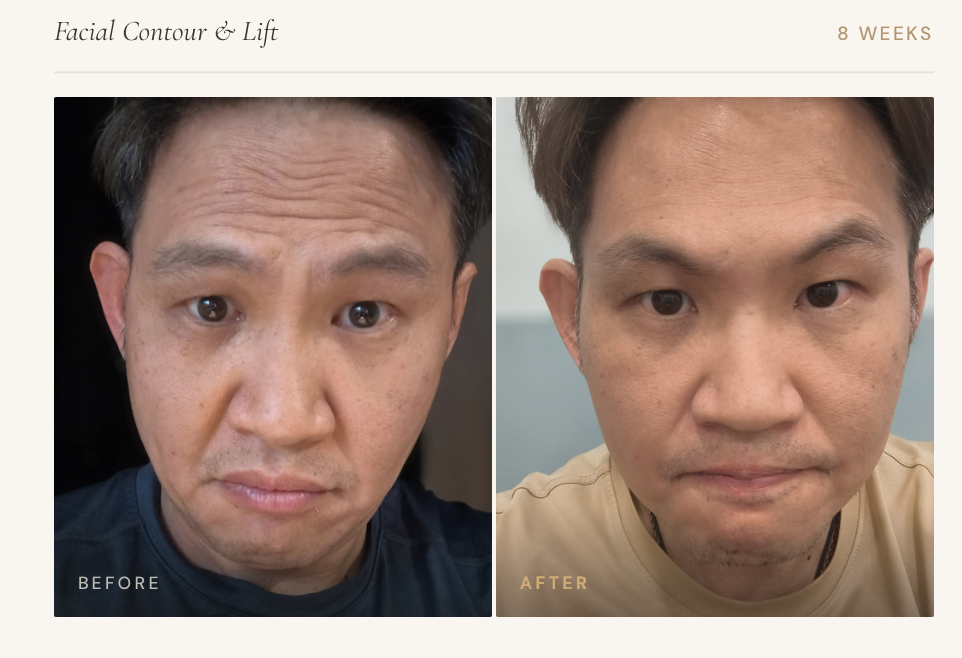Facial Contour and Lift — Before and After 8 Weeks